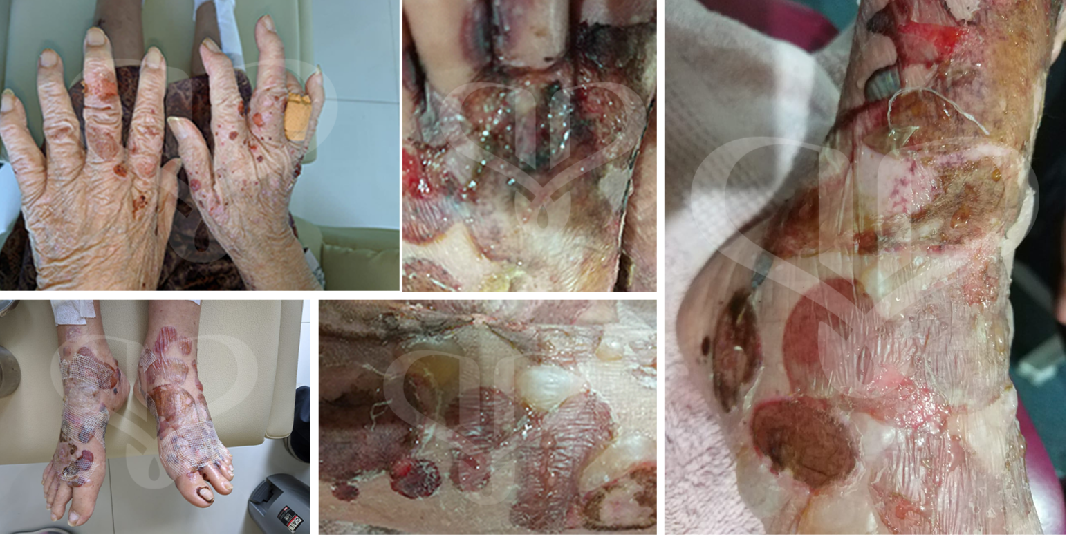 Kondisi awal pasien pemfigus bullosa